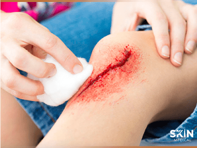 Limpieza de laceración profunda en rodilla infantil con gasa estéril para curación avanzada de heridas y prevención de cicatrices