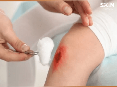 Heridas que No Cicatrizan: Cómo Identificarlas y Tratarlas