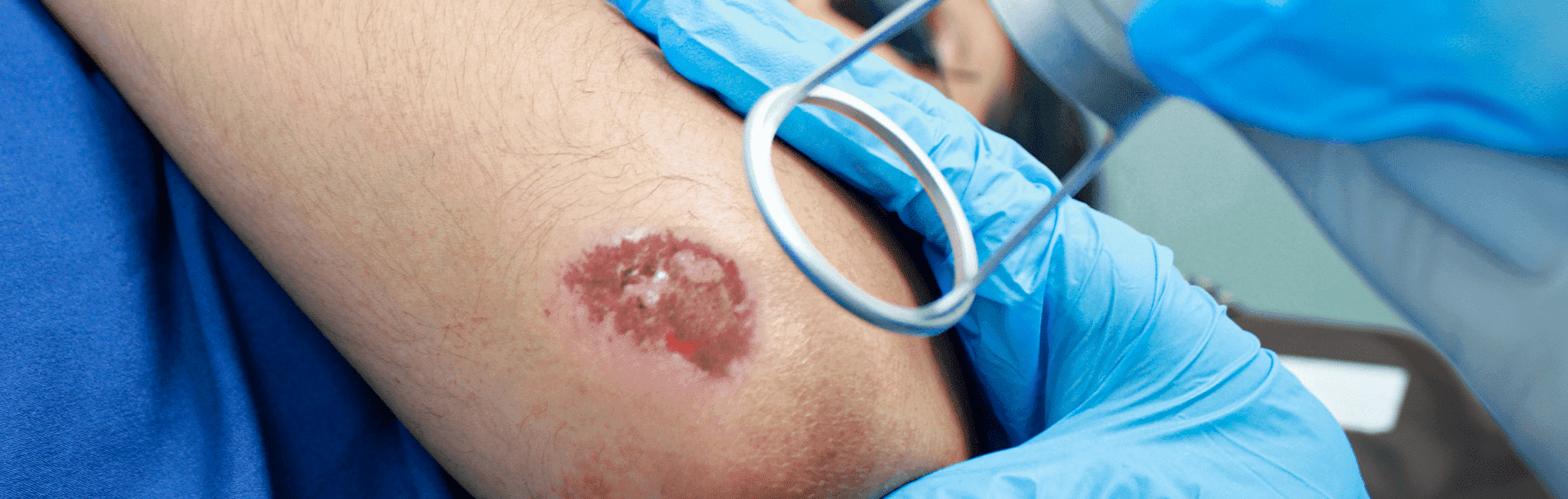 tratamiento de heridas