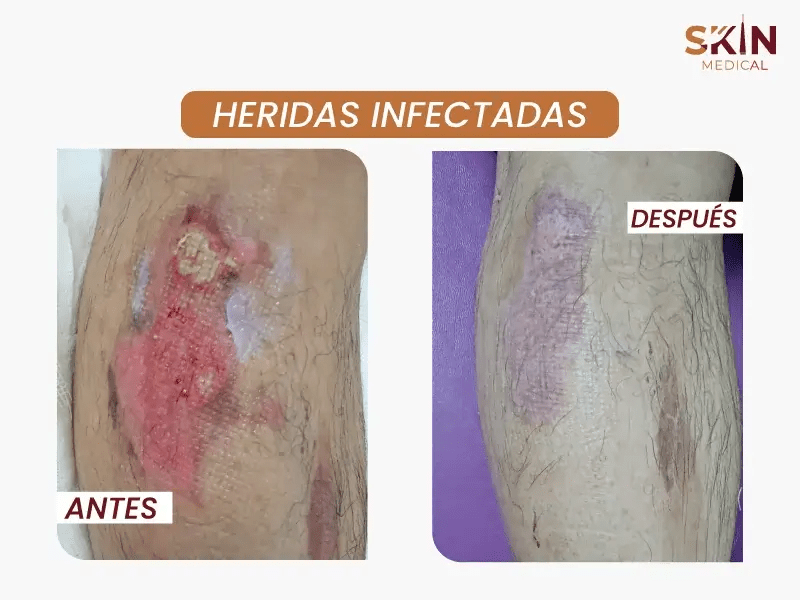 tratamiento de heridas