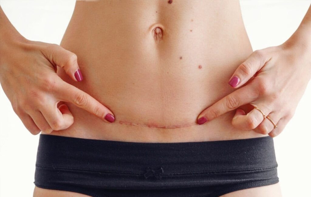 Cicatriz de cesárea en abdomen bajo de mujer, candidata a tratamiento médico de cicatrices y regeneración cutánea