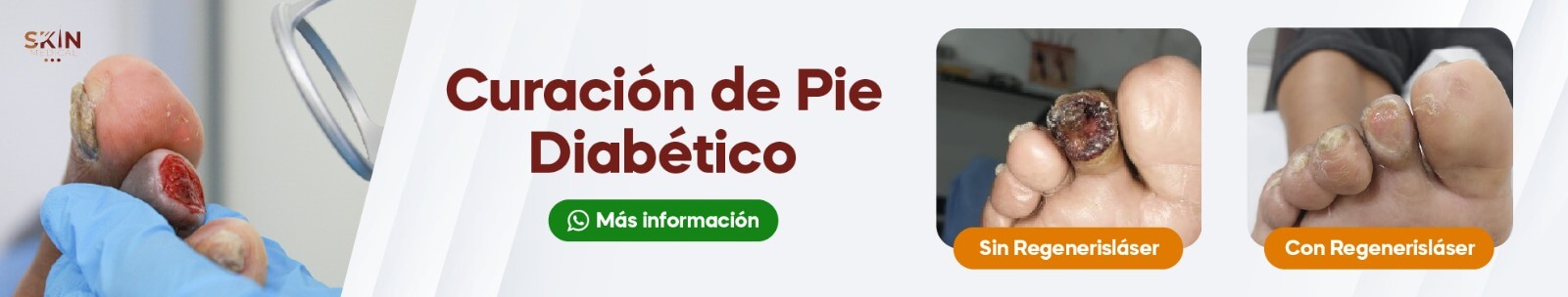 curacion de pie diabetico