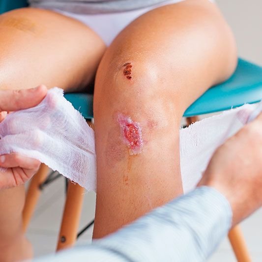 Médico tratando abrasión de rodilla con gasa para curación avanzada de heridas