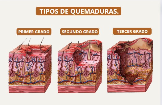 Descubre los tipos de quemaduras, desde leves hasta graves