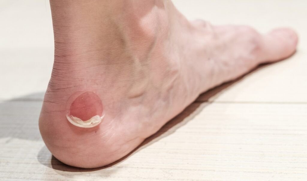 Ampolla por roce en el talón, ideal para tratamiento de curación avanzada de heridas y regeneración cutánea en SkinMedical