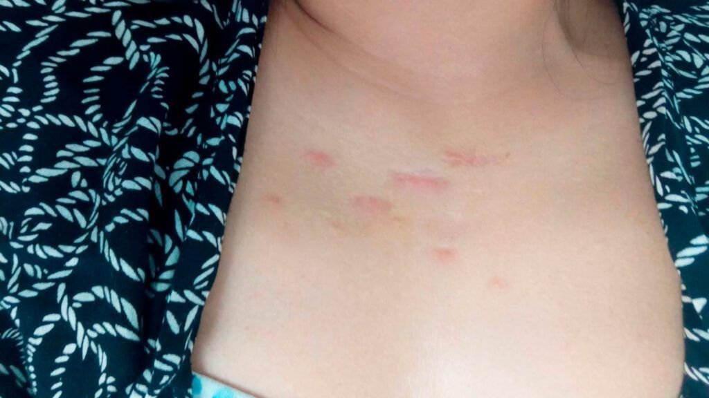 Cicatrices queloides en el pecho de una persona, tratamiento en skin medical