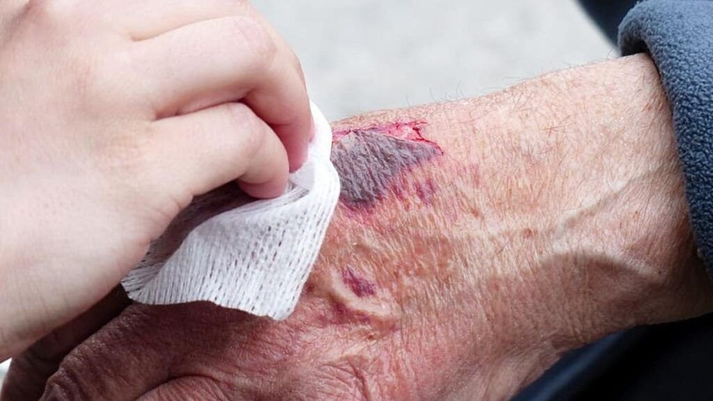 Limpiando herida en mano de paciente, enfocado en curación avanzada de heridas y piel diabética.