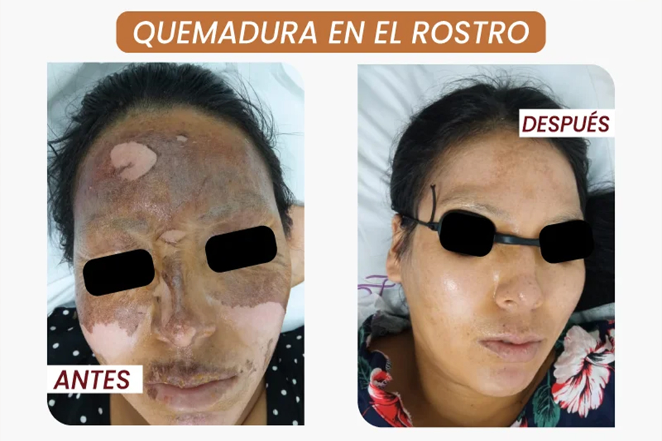 curacion de quemaduras con laser