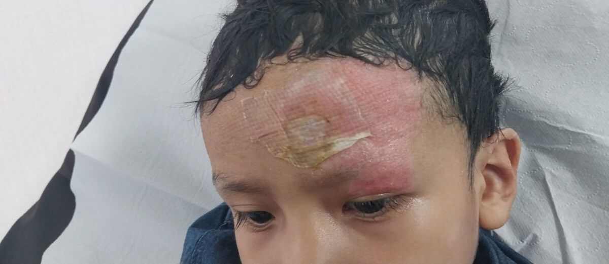 niños quemados
