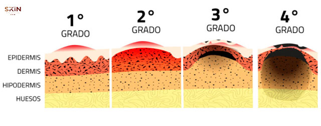 tipos de quemaduras