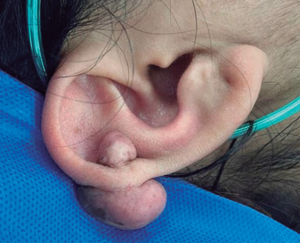 queloide en la oreja