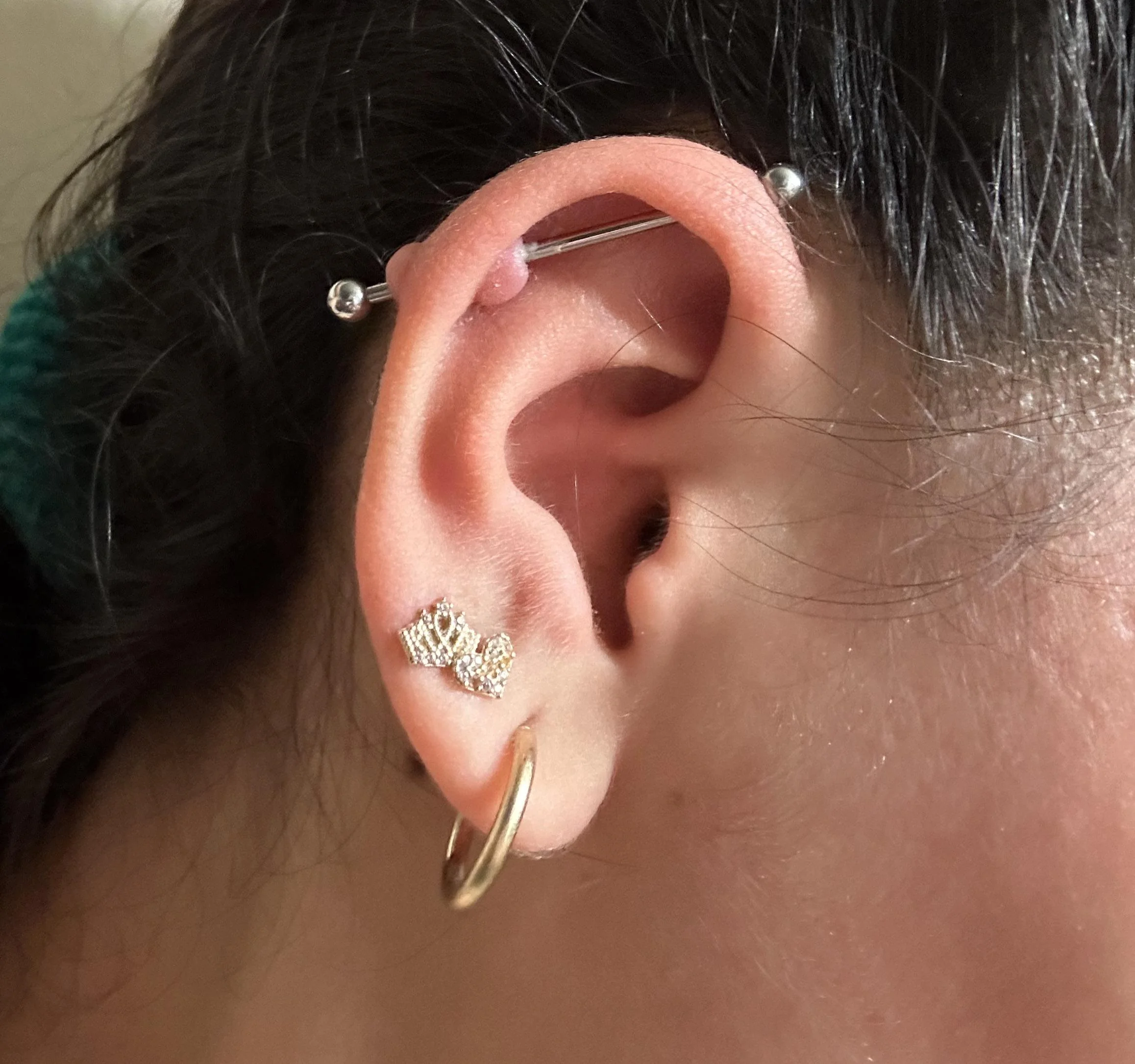 queloide en la oreja