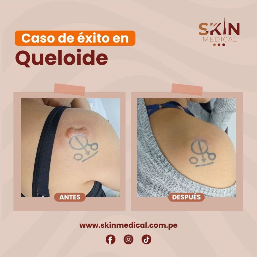 Antes y despues de una cicatriz queloide tratada en Skin Medical