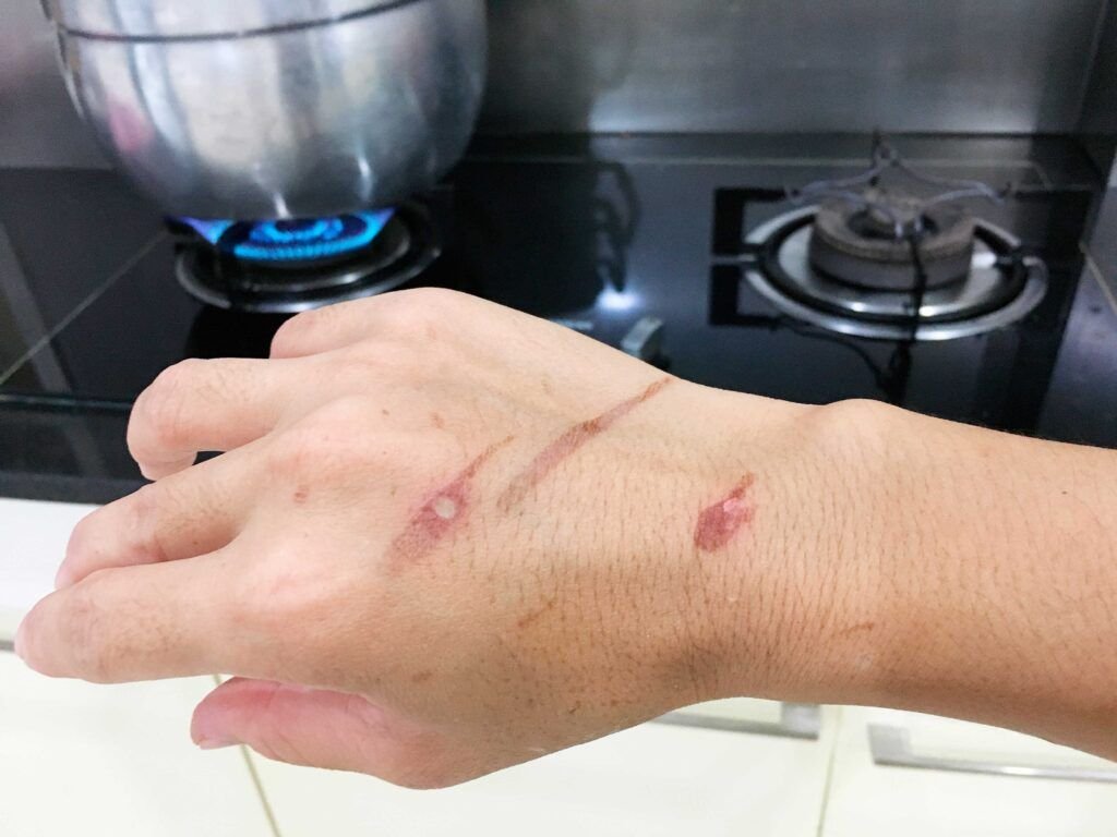 Mano con cicatrices por quemaduras en la cocina, candidata a tratamiento láser de cicatrices y regeneración cutánea en SkinMedical