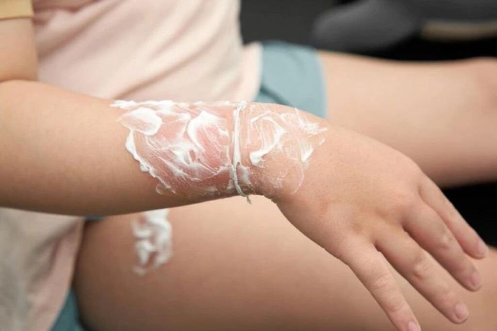 Quemadura en el brazo con agua hervida tratado en Skin Medical