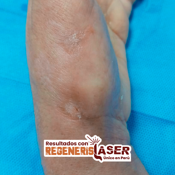 tratamiento de heridas con regenerislaser