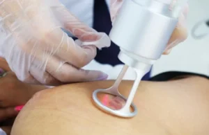 Tratamiento con Láser para Cicatrices en Lima