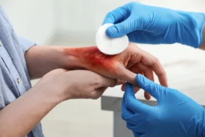 Cómo se Regenera la Piel Después de una Quemadura