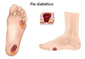 Pie diabético con múltiples úlceras abiertas en la planta y dedos, y detalle de herida profunda en capas de piel.