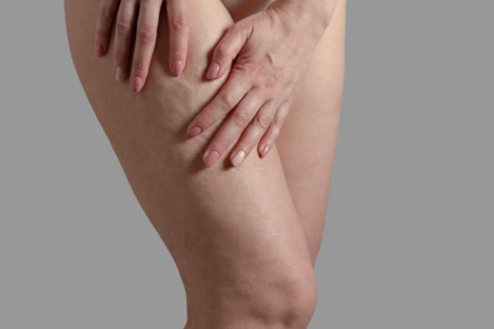 estrias en las piernas