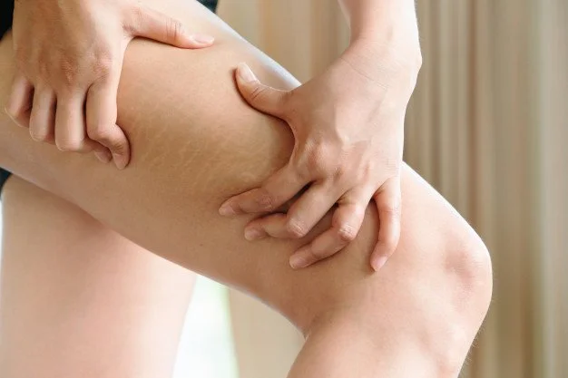 estrias en las piernas