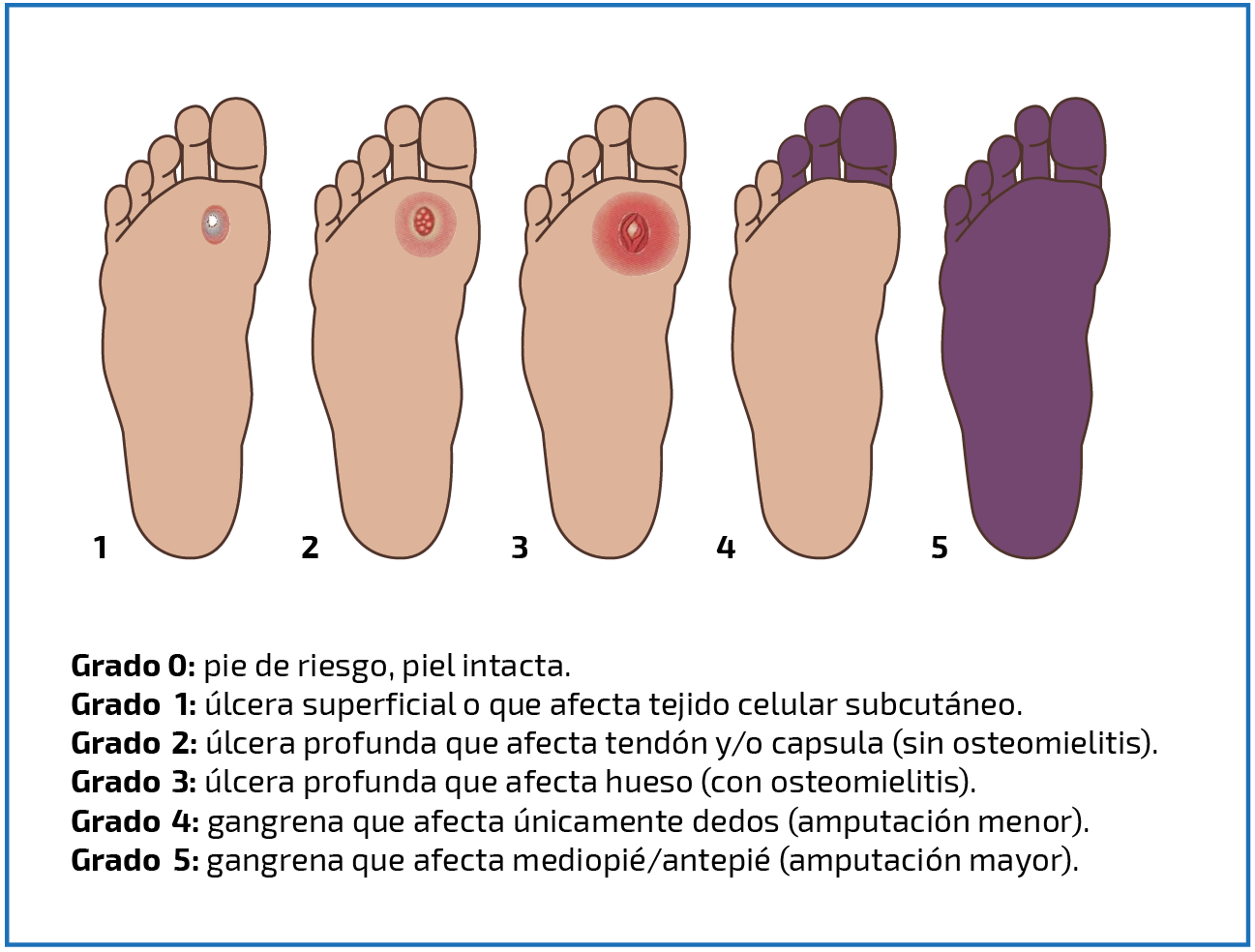 Clasificación de Wagner para pie diabético: úlceras superficiales, profundas y gangrena con amputación.