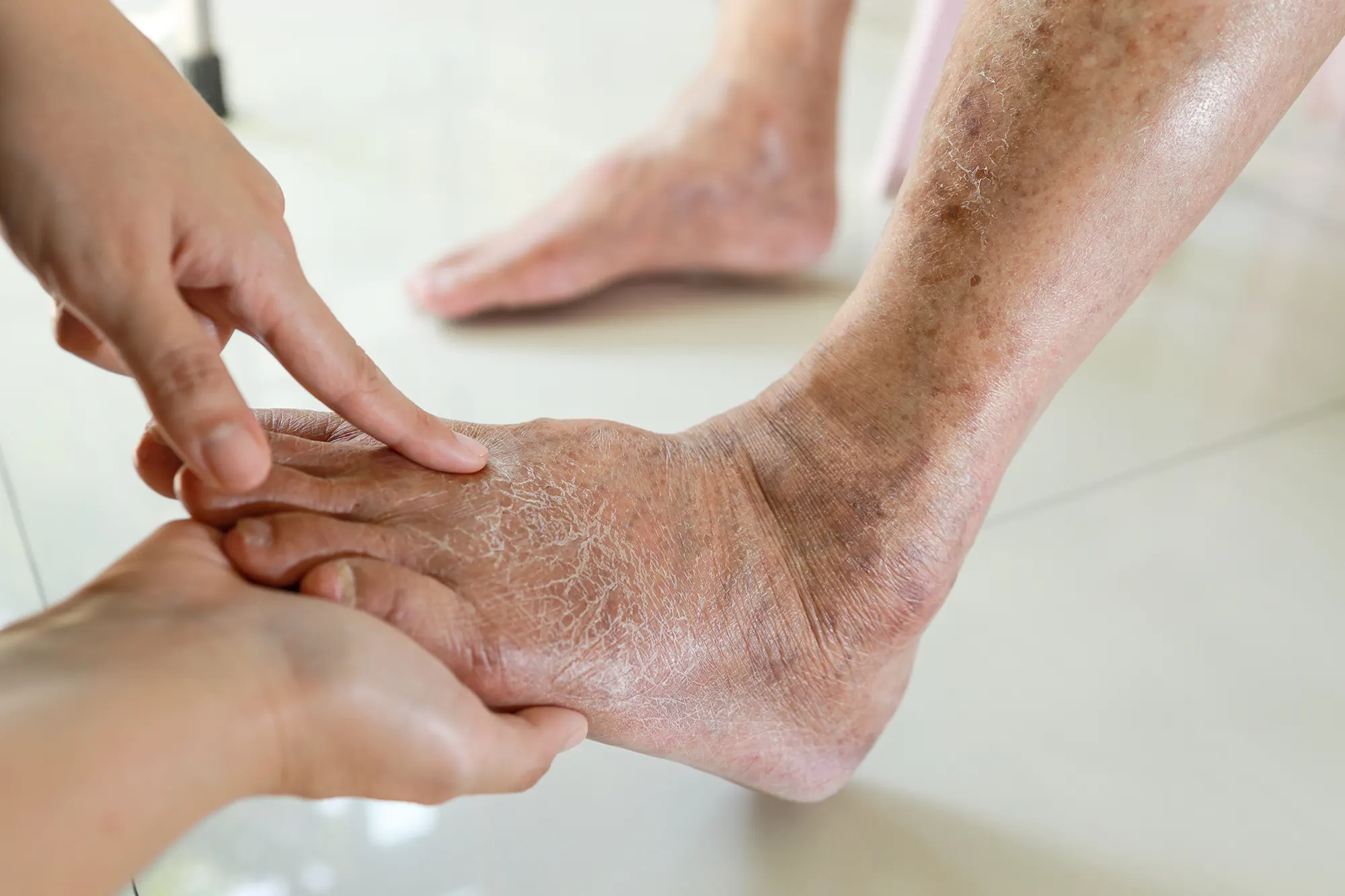 Síntomas más comunes de la diabetes​