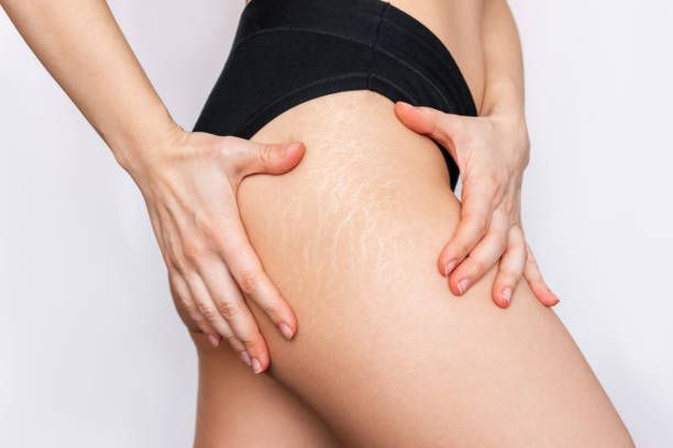 estrias en las piernas