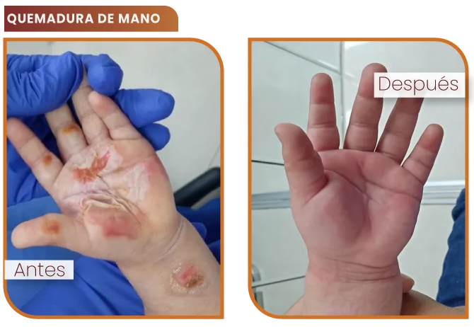 tratamiento de quemaduras de mano