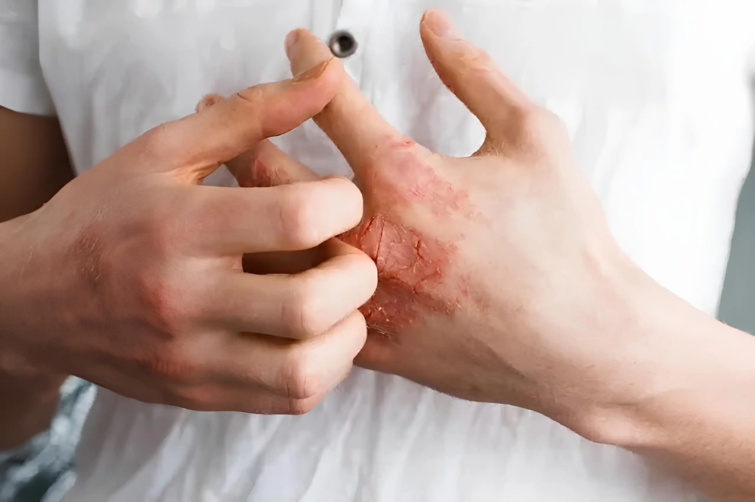 Úlceras arteriales en la mano