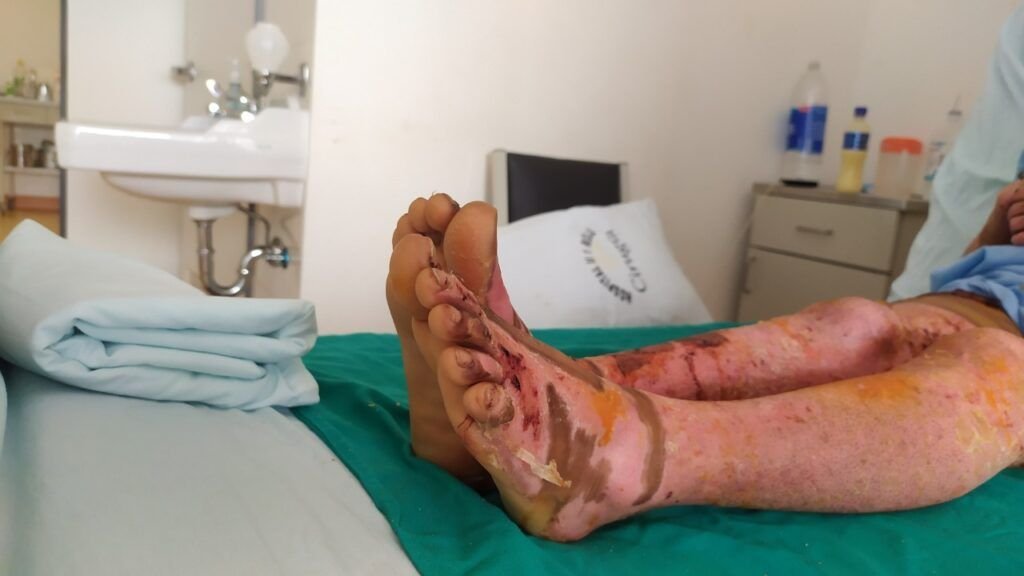 Primeros auxilios quemadura Lima Skin Medical