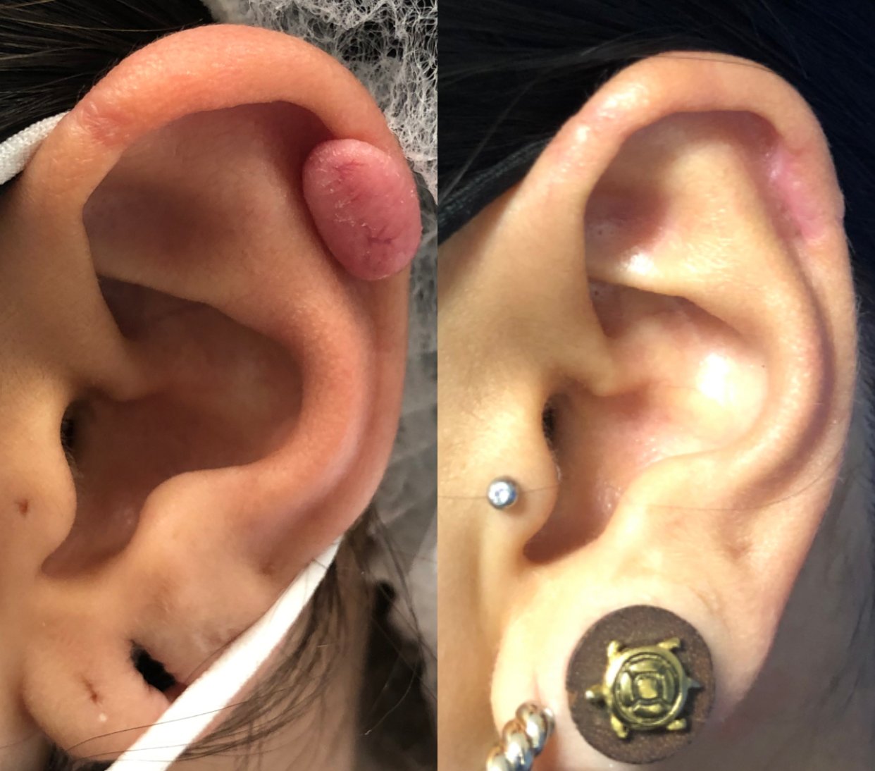 Antes y después de tratamiento láser en queloide del cartílago de la oreja por perforación, mejorando cicatriz gruesa y aspecto de la piel