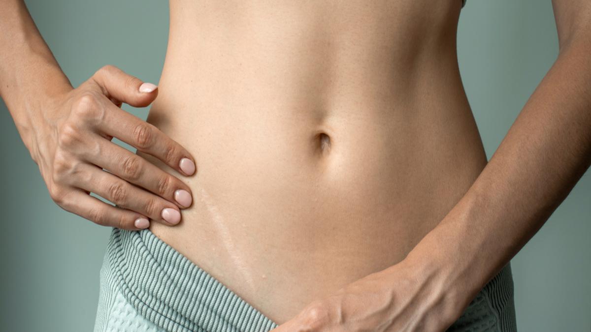 apendicitis