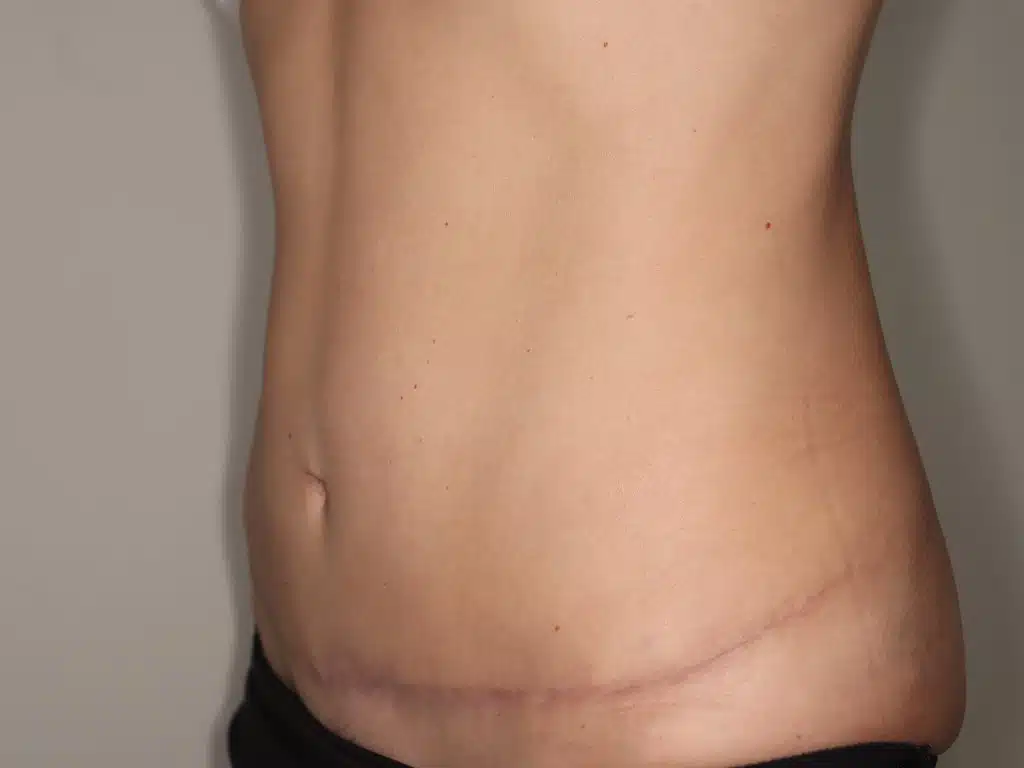 cicatrices de apendicitis, abdominoplastia cicatriz