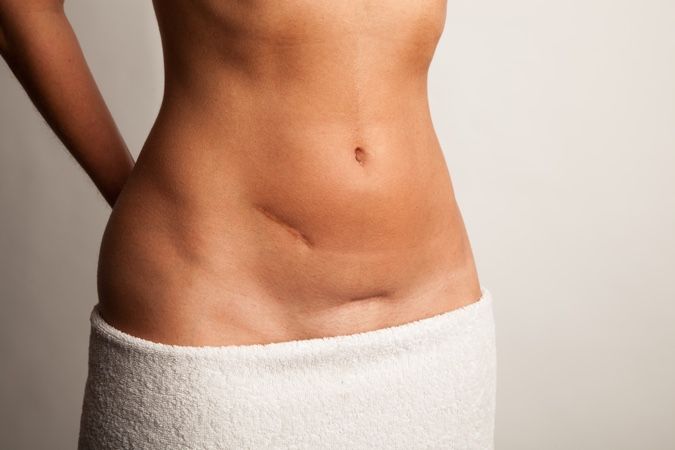 cicatrices de apendicitis, abdominoplastia cicatriz