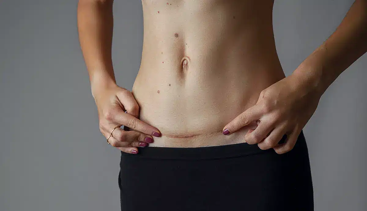 cicatriz de apendicitis​ y abdominoplastia