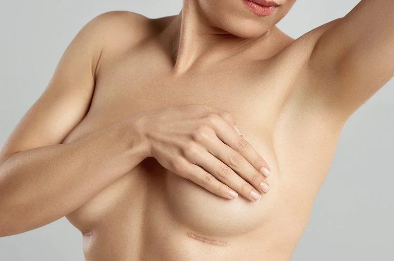 como eliminar cicatrices de cirugia de senos, cicatriz mastopexia, cicatrices mamoplastia