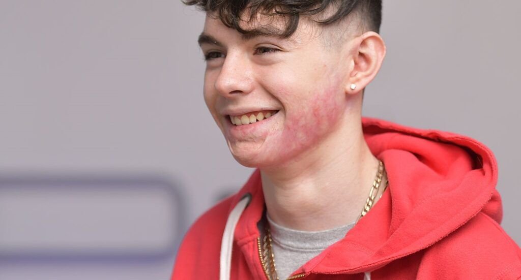 cicatriz de una quemadura