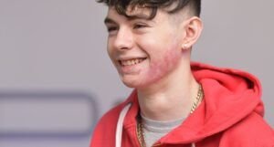 cicatriz de una quemadura