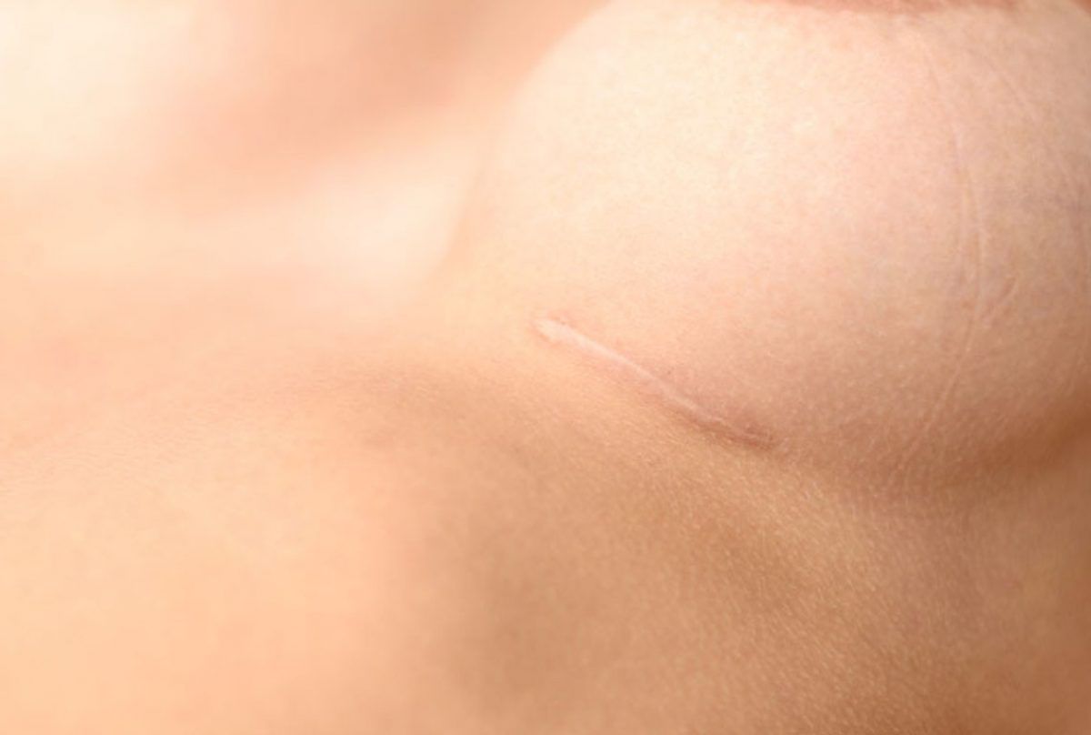como eliminar cicatrices de cirugia de senos, cicatriz mastopexia, cicatrices mamoplastia