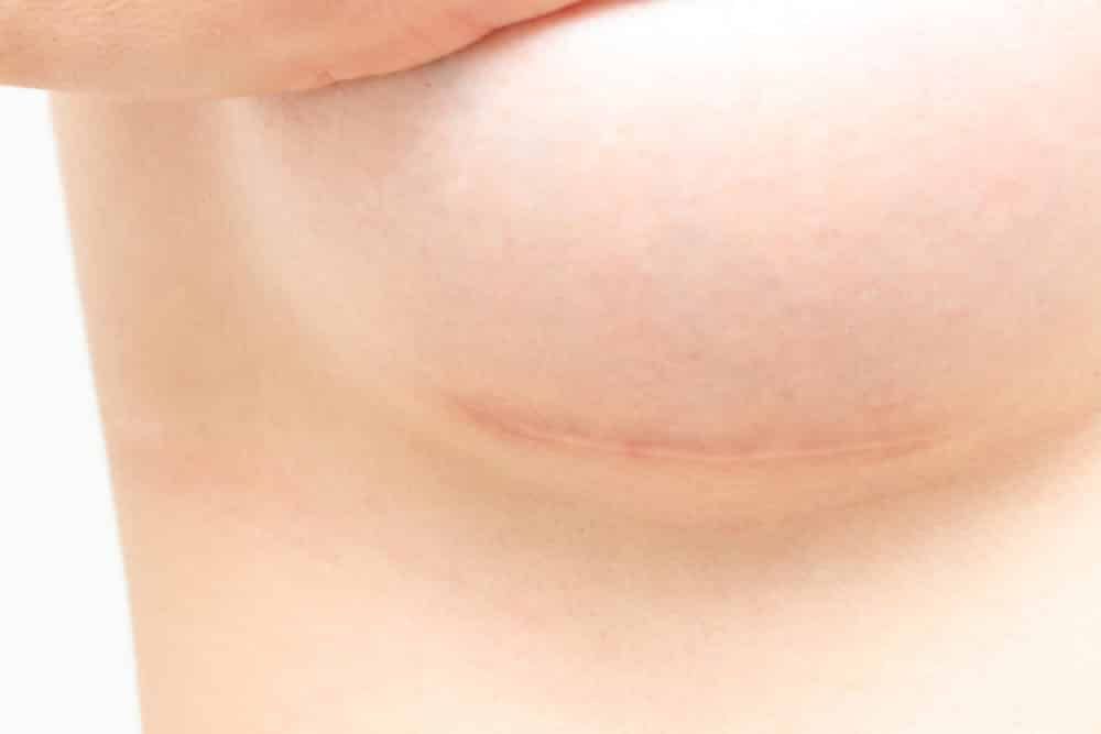 como eliminar cicatrices de cirugia de senos, cicatriz mastopexia, cicatrices mamoplastia