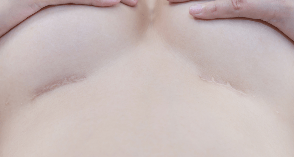 como eliminar cicatrices de cirugia de senos, cicatriz mastopexia, cicatrices mamoplastia