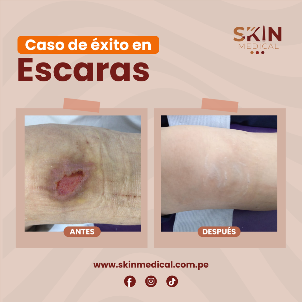 escaras: antes y despues