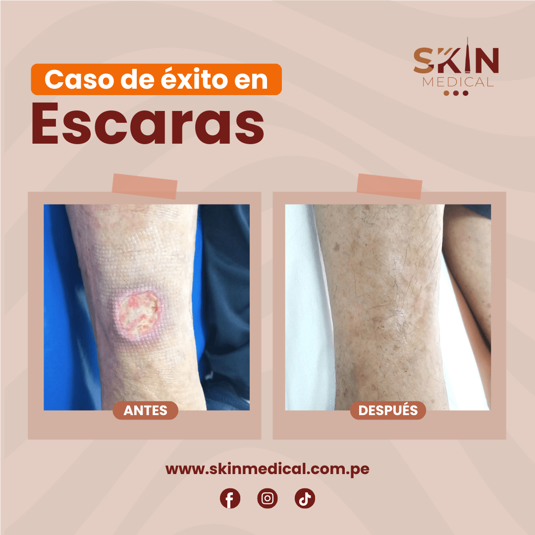 Antes y despues de escaras en skin medical