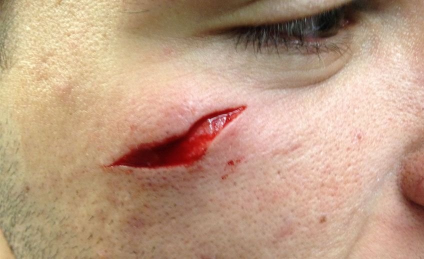 heridas cortantes o heridas lacerantes