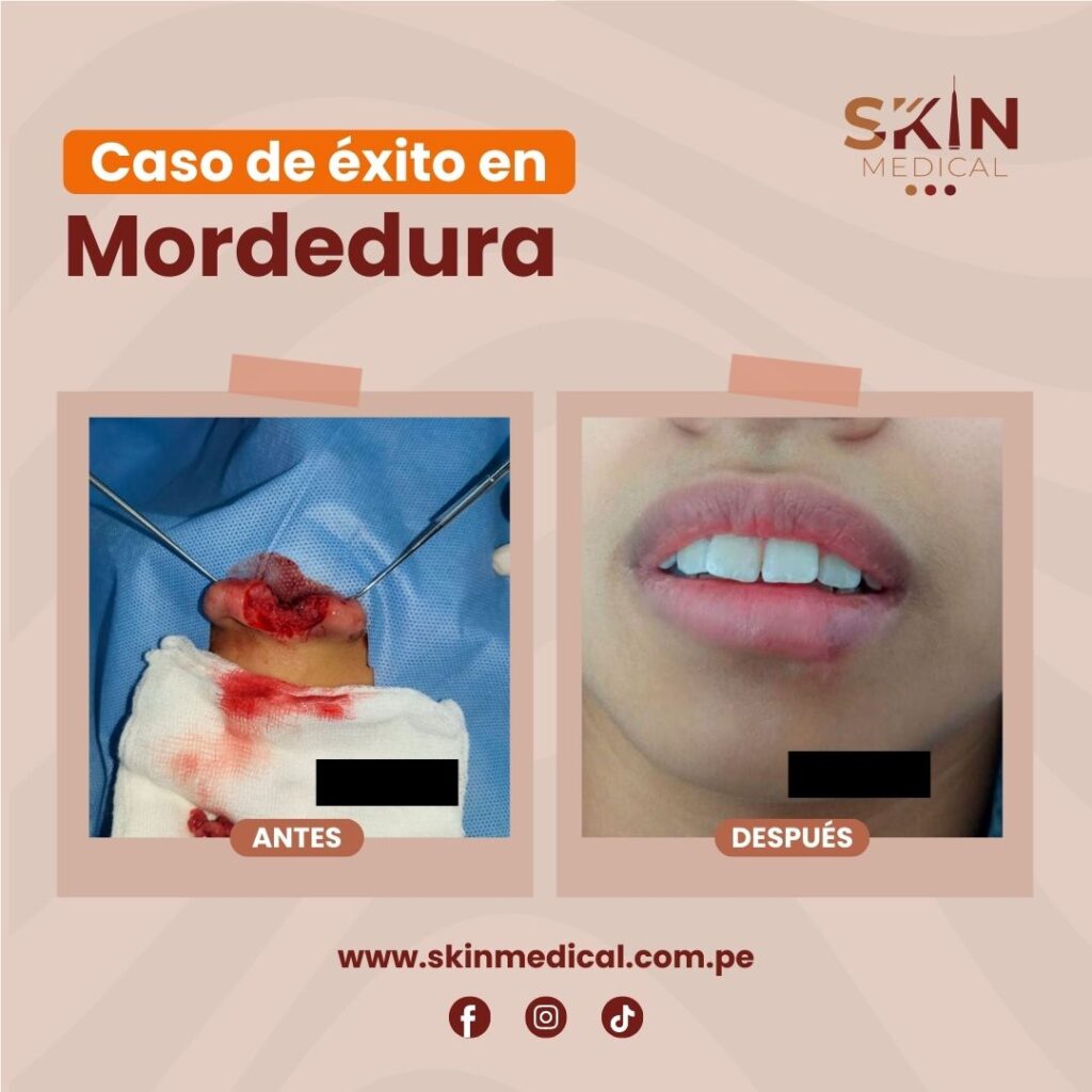 mordedura