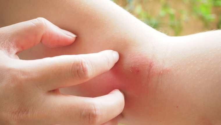 Mano examinando una picadura de araña infectada en el brazo, con piel roja e hinchada.