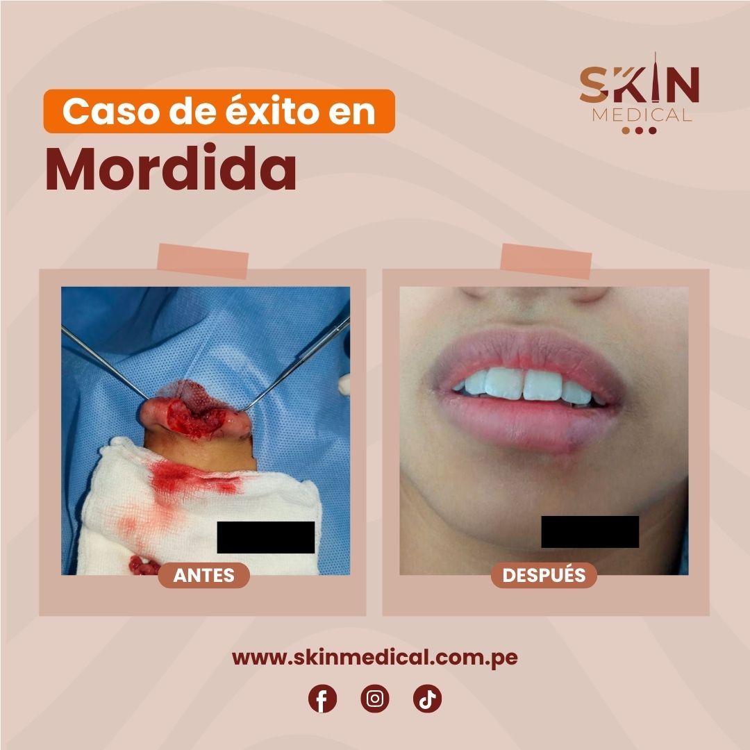 mordedura humana tratamiento