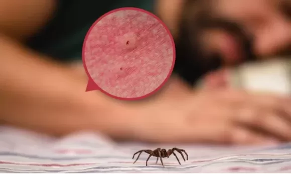 Araña cerca del brazo de una persona en la cama; zoom muestra mordedura de araña infectada en la piel.