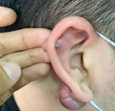 Queloide grande en lóbulo de la oreja causado por perforación, cicatriz abultada que puede tratarse con láser para mejorar la herida y el aspecto de la piel